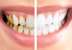 Zahnfarbe häufigste Die passende